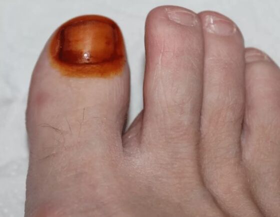 Treatment of fungus iodine