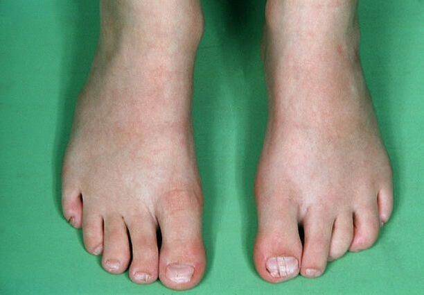 The fungus in the legs