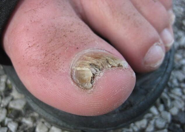 The result of negligence