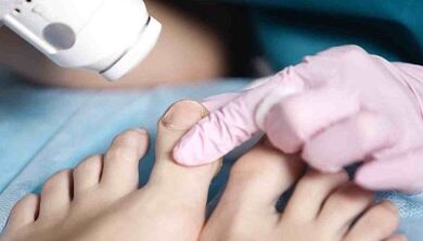 Leg fungi hardware treatment