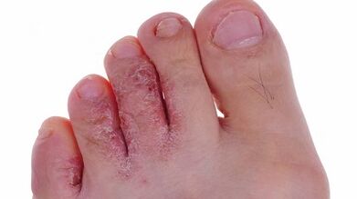 Types and stages of leg development in the legs