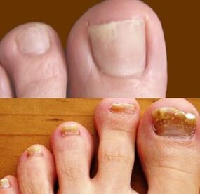 Initial and advanced stages of foot fungus.