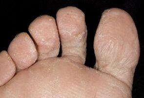 Symptoms of fungus on the skin of the feet.