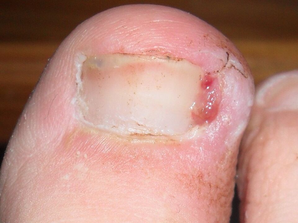 Ingrown toenail as a symptom of a fungal infection.