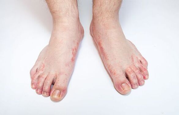 Fungal disease of the skin of the feet.