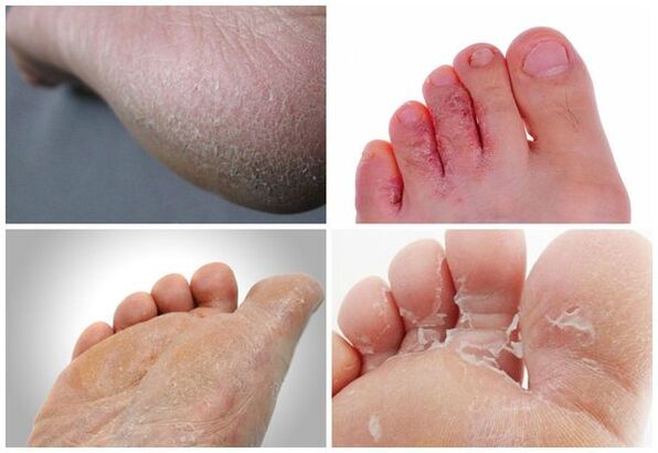 The main manifestations of mycosis of the feet are keratinization of the skin, cracks, peeling.