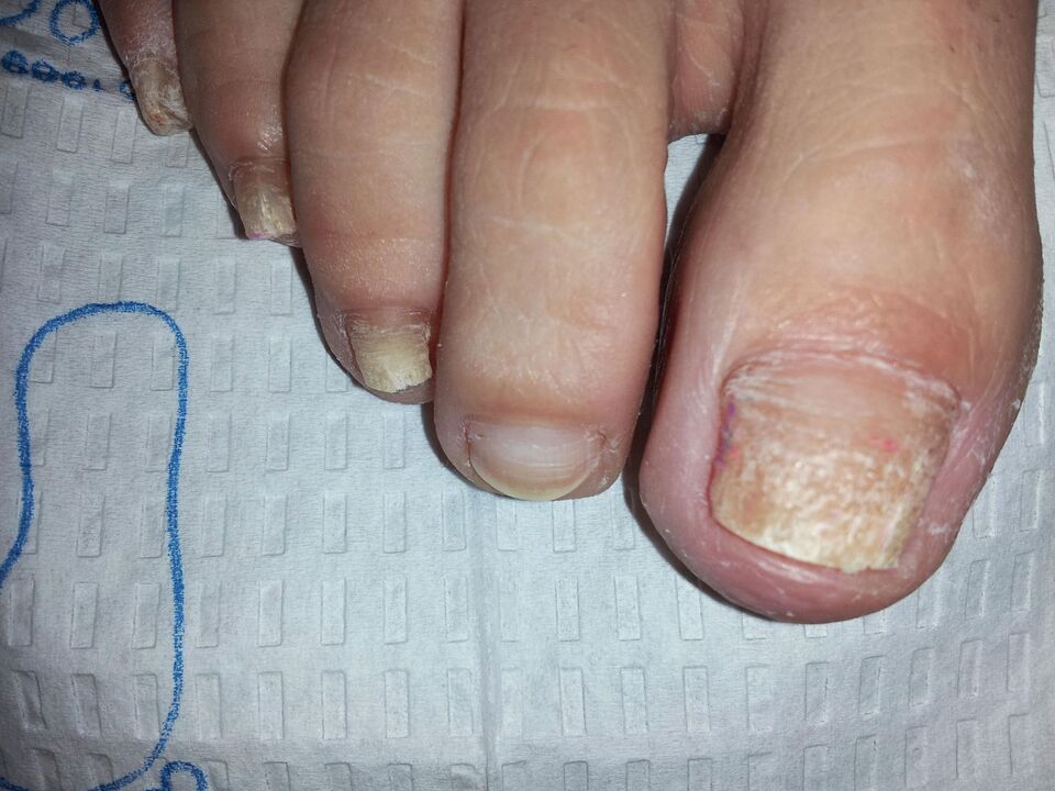 How to treat toenail fungus with celandine.