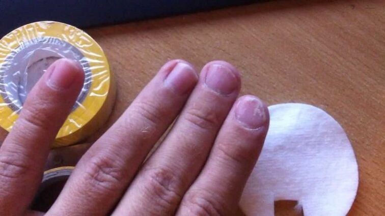 nail fungus and its treatment with home remedies