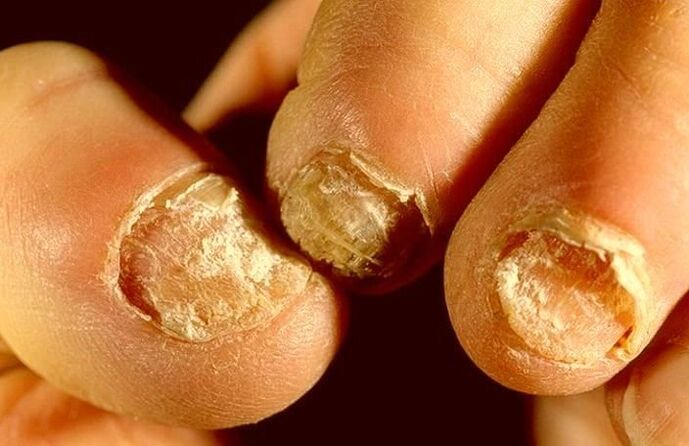 nail fungus how to treat
