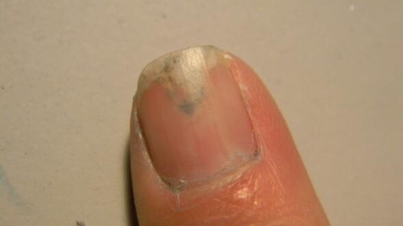 nail fungus symptoms