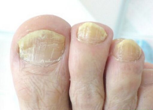 Advanced toenail fungus.