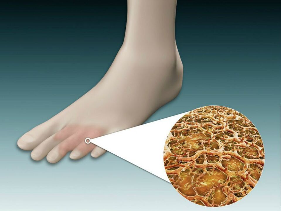 Redness of the skin between and near the toes with intertriginous fungus. 